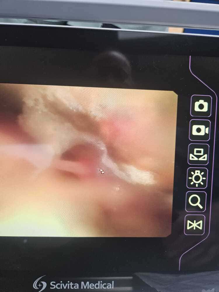 endoscopie aspergillose