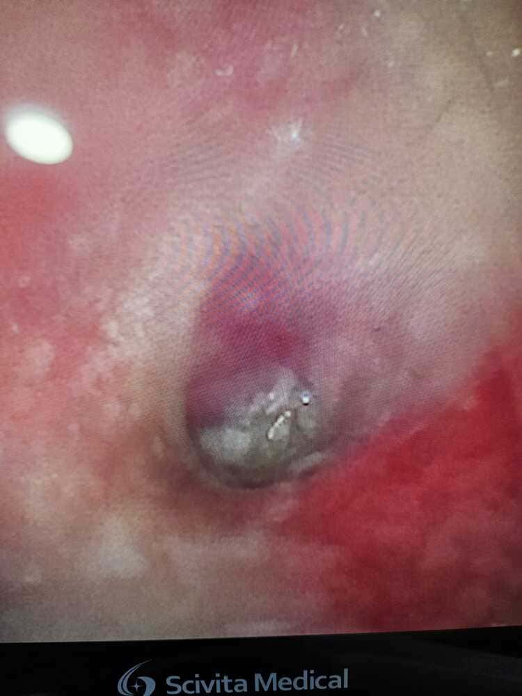 endoscopie otite purulente